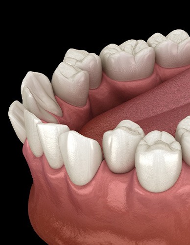 Illustration of crooked teeth