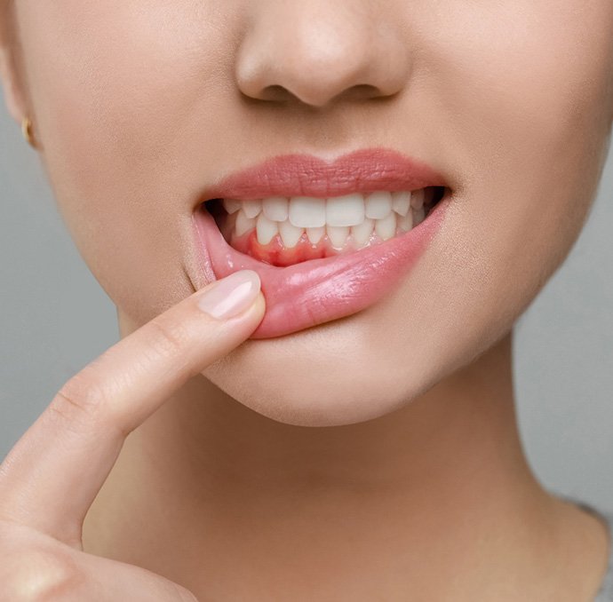 Nose-to-neck view of woman pulling down lip to reveal dark gums