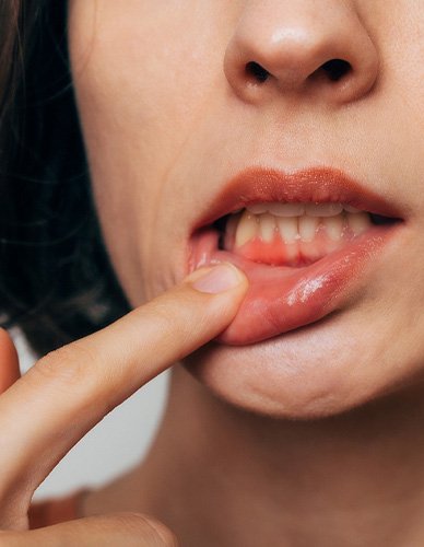 Woman with irritated gum tissue