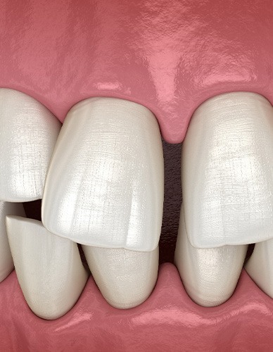 Illustration of gapped teeth