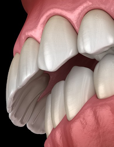 Illustration of an overbite