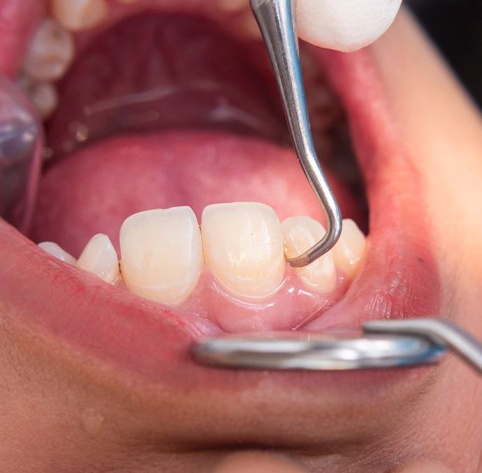 Closeup of someone’s gums being cleaned