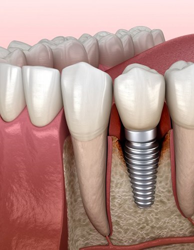 a 3D illustration of a dental implant in the jawbone