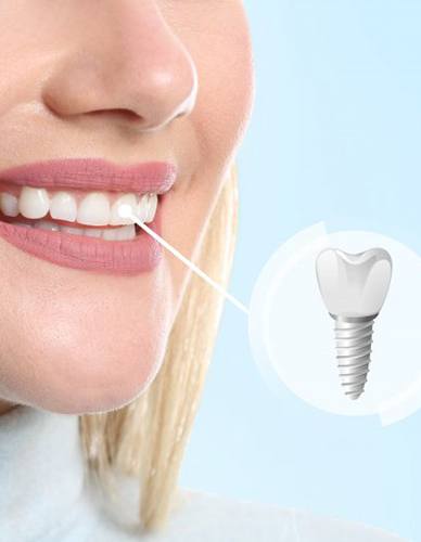 a woman smiling with a dental implant