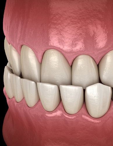 Illustration of an underbite