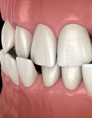 Illustration of a crossbite