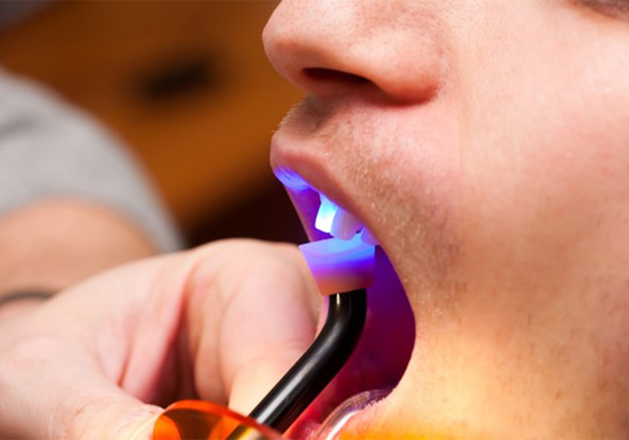 Close up of a dental patient receiving cosmetic bonding on a front upper tooth