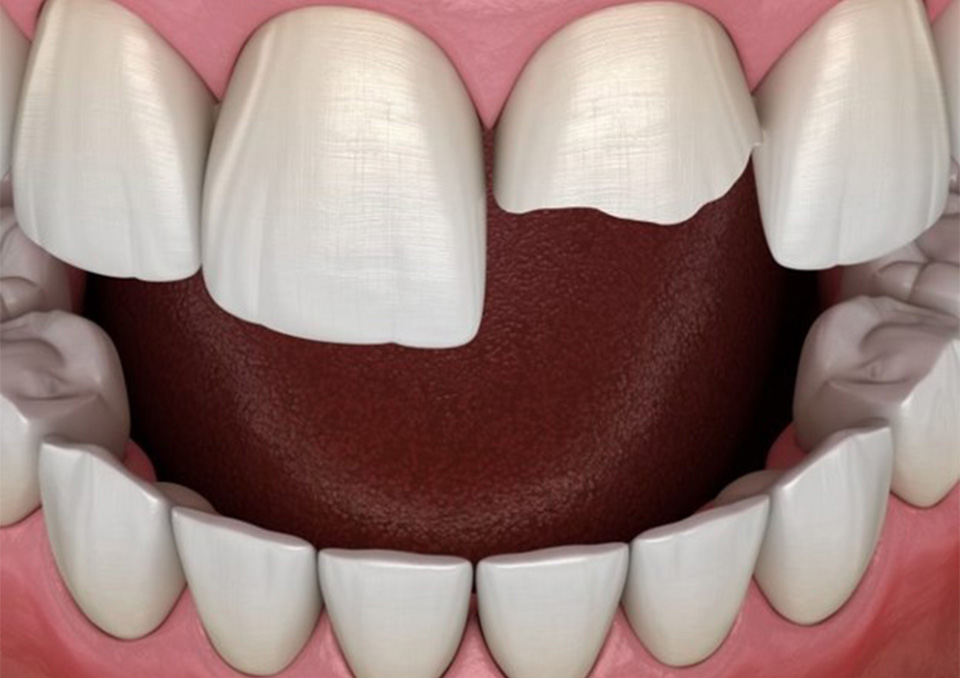 Illustration of a mouth with a chipped upper front tooth