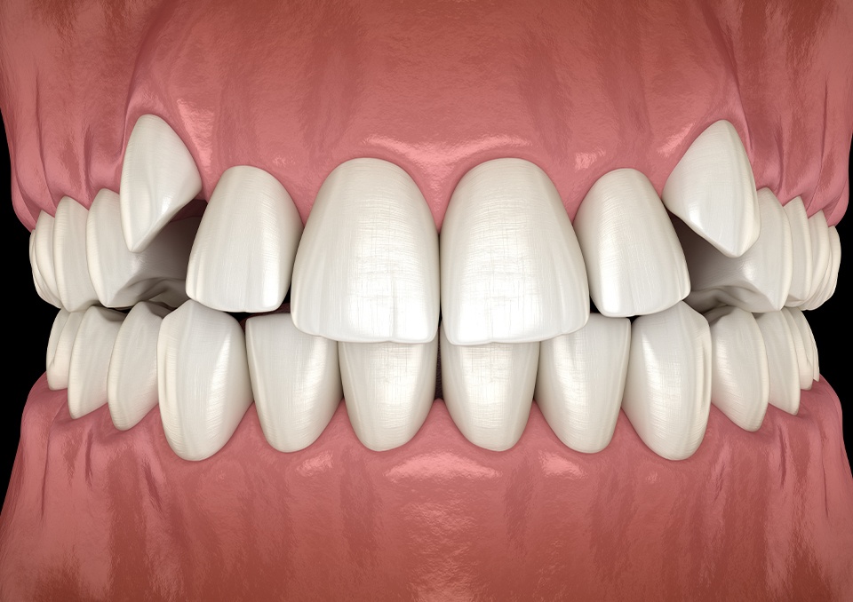 Happy patient holding Candid clear aligners in Richardson