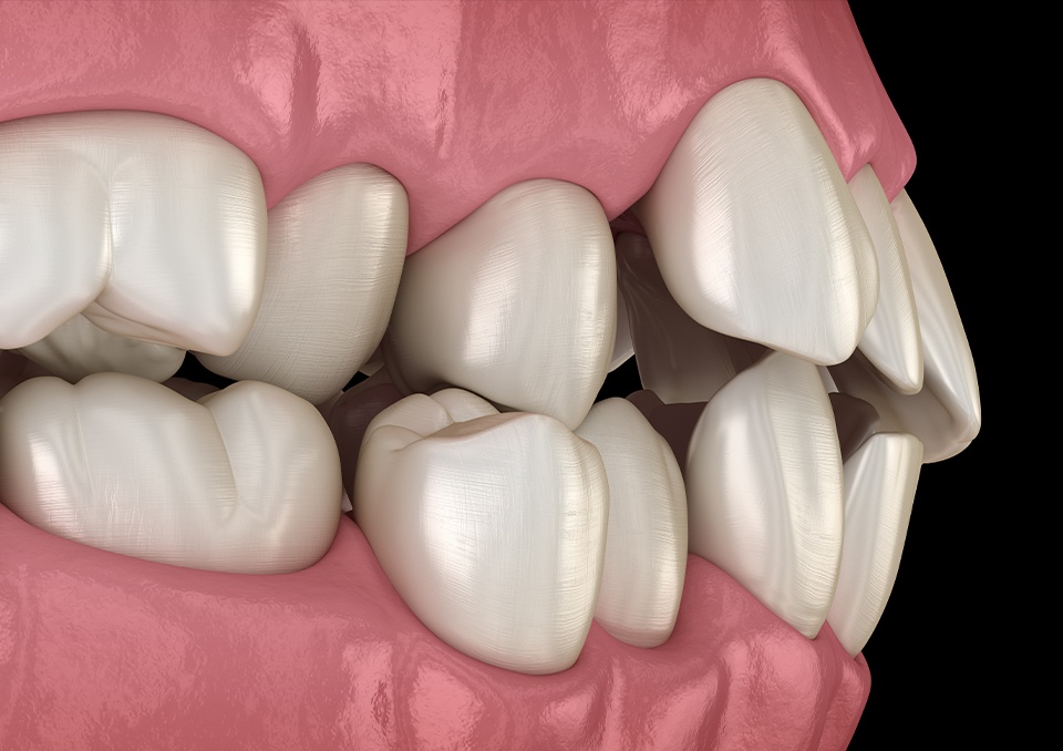 Happy patient holding Candid clear aligners in Richardson