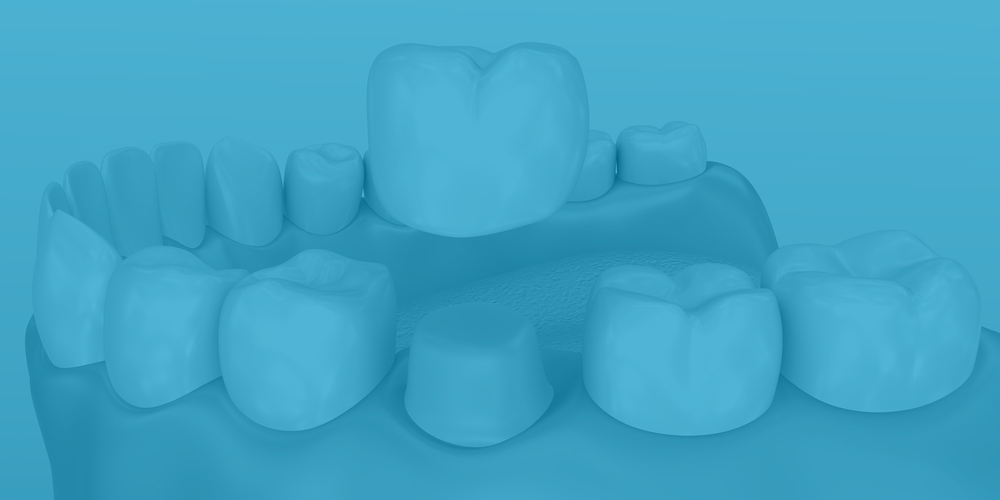 Animated smile during dental crown placement