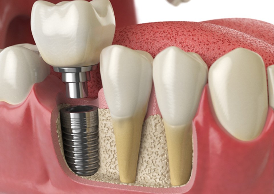 Digital illustration of dental implants in Richardson 