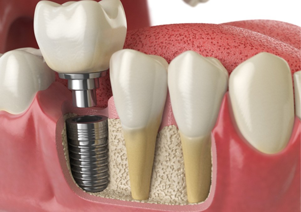 Digital illustration of dental implants in Richardson
