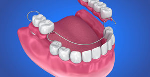 Animated smile with partial denture
