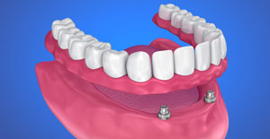 Animated smile with dental implant supported denture