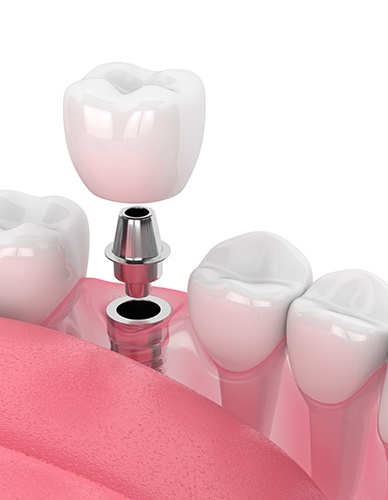 Illustration of single dental implant