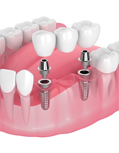 Illustration of implant bridge