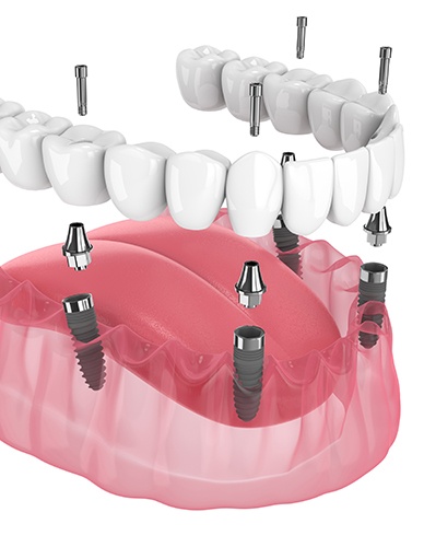 Illustration of implant denture