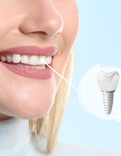Nose to chin view of woman smiling with one tooth noted as a dental implant