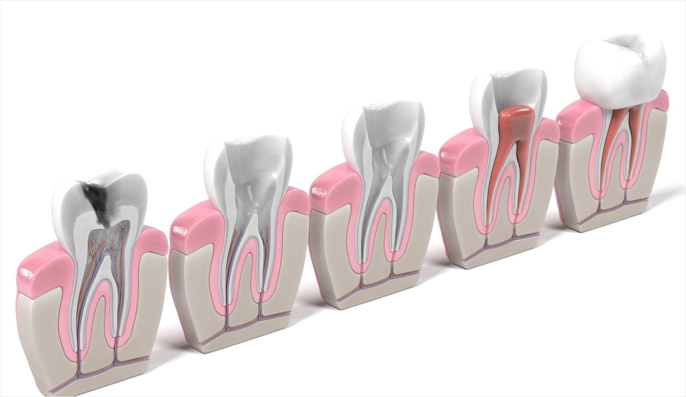 Model of healthy teeth compared to damaged teeth and root canal treated teeth