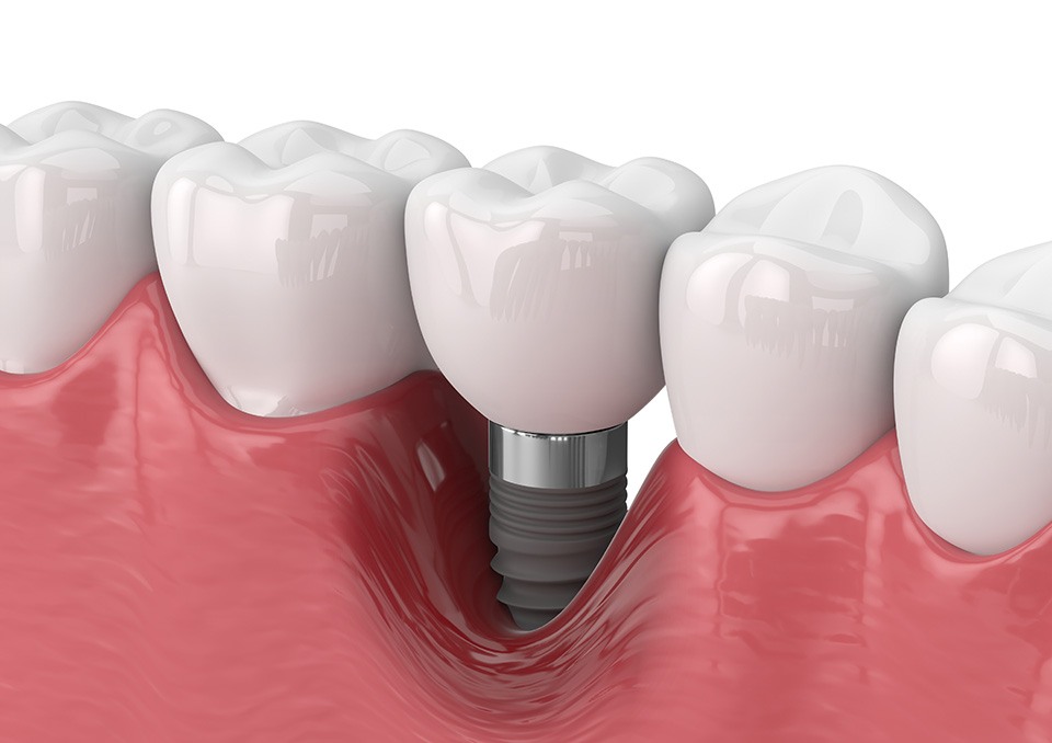 Illustration of bone loss around failed dental implant in Richardson, TX
