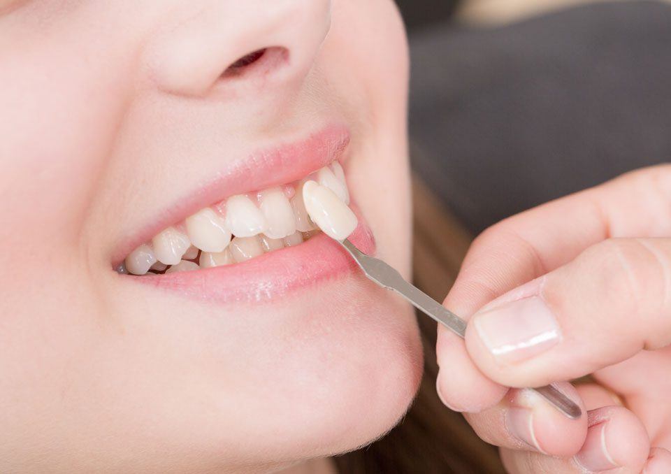 Closeup of smile compared with porcelain veneer shade