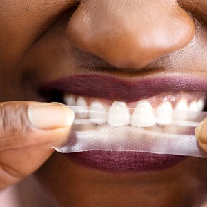 Closeup of patient using whitening strip