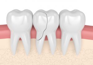 CGI image of 3 teeth with a crack in the center one