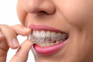 Woman using clear plastic aligner.