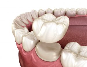 Illustration of dental crown being placed on tooth in lower arch