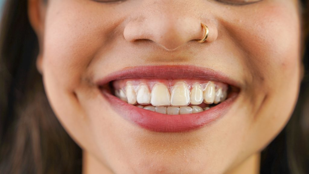 Closeup of patient smiling while wearing their aligners