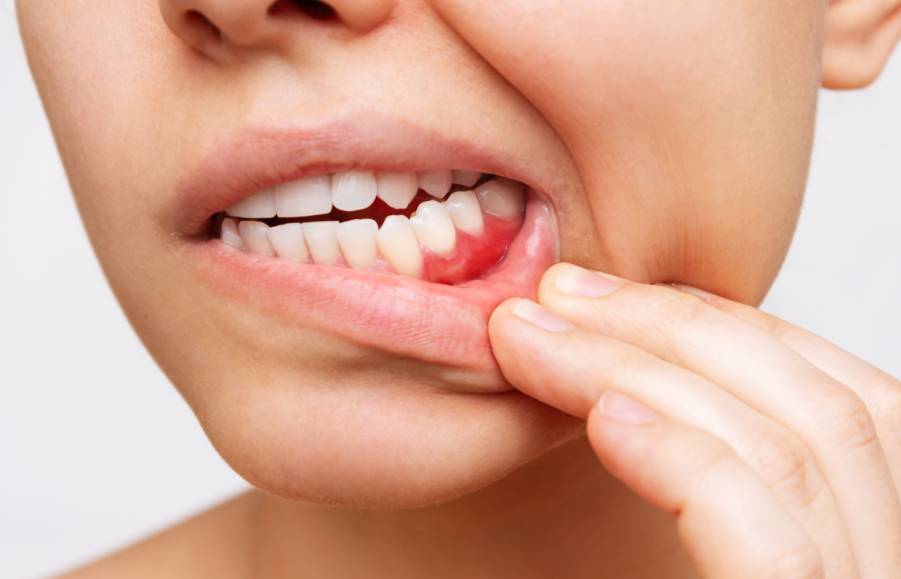 Close up of woman's mouth as she pulls down her lip to show her gums.